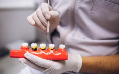 Dental Fillings Parkway Clinic Dental Fillings Parkway Clinic