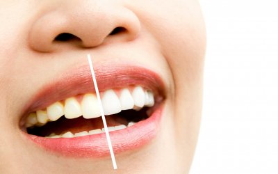 Teeth Whitening Parkway Clinic Teeth Whitening Parkway Clinic