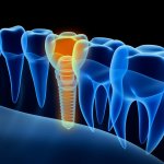 Dental Implants Parkway Clinic Dental Implants Parkway Clinic