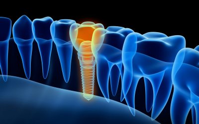 Dental Implants Parkway Clinic Dental Implants Parkway Clinic