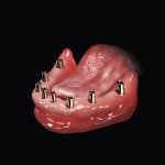 AnyRidge Teeth in a day Implants Parkway Clinic AnyRidge Teeth in a day Implants Parkway Clinic