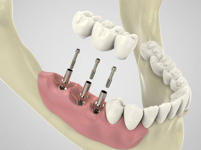 AnyRidge Teeth in a day Implants Parkway Clinic AnyRidge Teeth in a day Implants Parkway Clinic