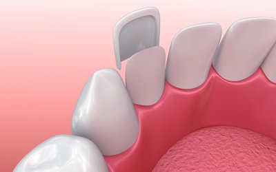 Veneers Parkway Clinic Veneers Parkway Clinic