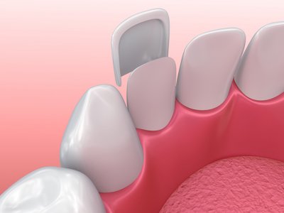 Veneers Parkway Clinic Veneers Parkway Clinic