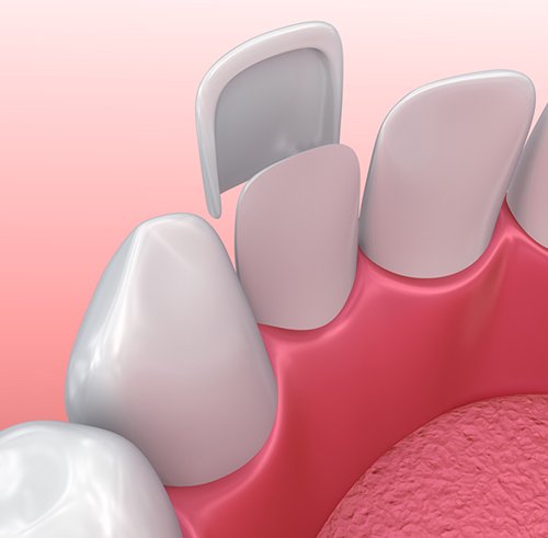Veneers Parkway Clinic Veneers Parkway Clinic