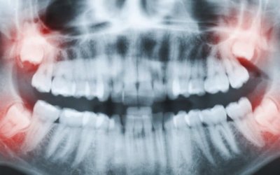 wisdom teeth Parkway Clinic wisdom teeth Parkway Clinic