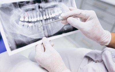 X-ray of teeth X-ray of teeth