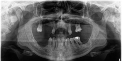 overton_estelle_before treatment overton_estelle_before treatment